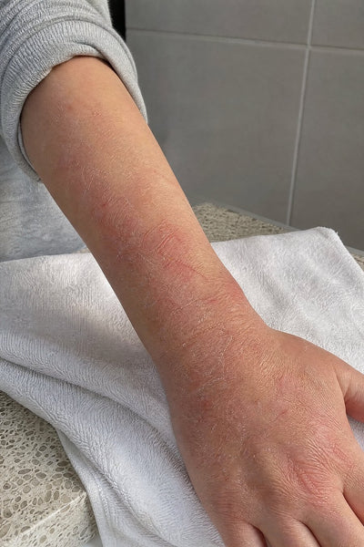 Forearms after the shower — before