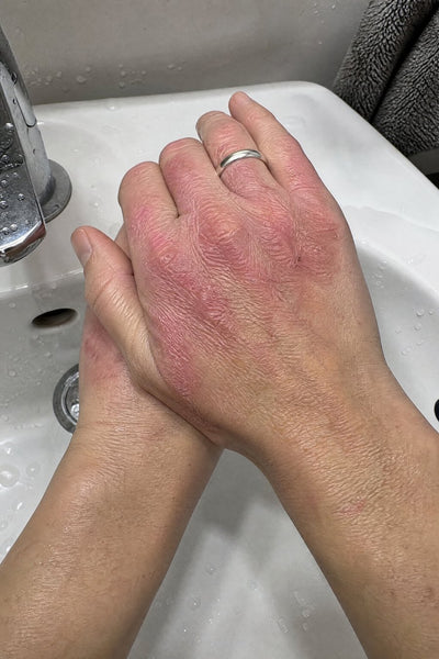 Hands and knuckles — before