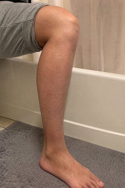 Shins — the ashy, scaly patch — before