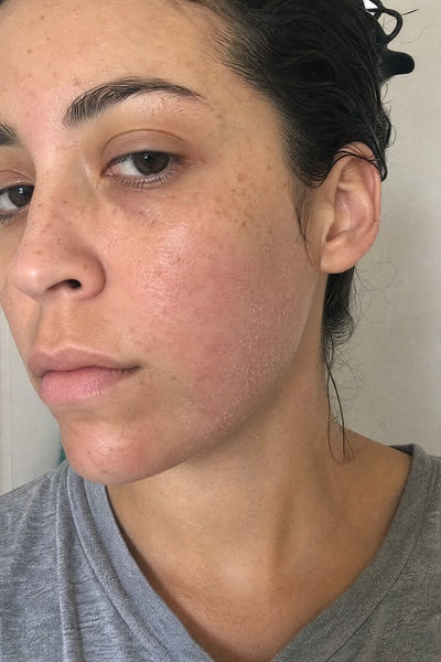Skin after the shower — before